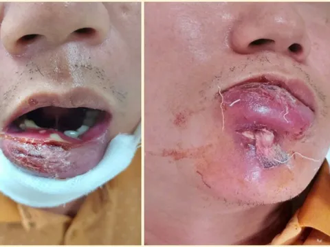 Người đàn ông 40 tuổi nhập viện với phần môi sưng tấy vì mắc sai lầm phổ biến