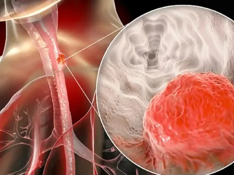 Nam giám đốc bất ngờ phát hiện ung thư giai đoạn 3: Hối hận vì đã bỏ qua 1 dấu hiệu suốt nhiều năm