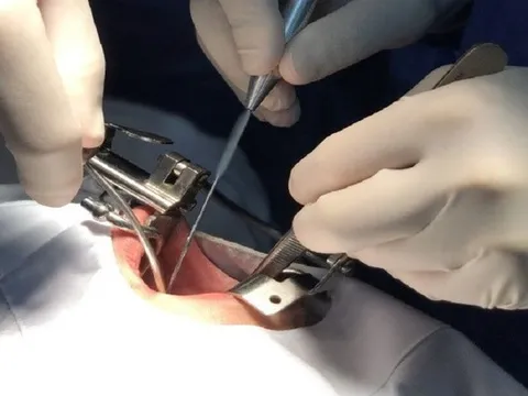Căn bệnh khiến bé trai 8 tuổi tự cắn đứt đầu lưỡi