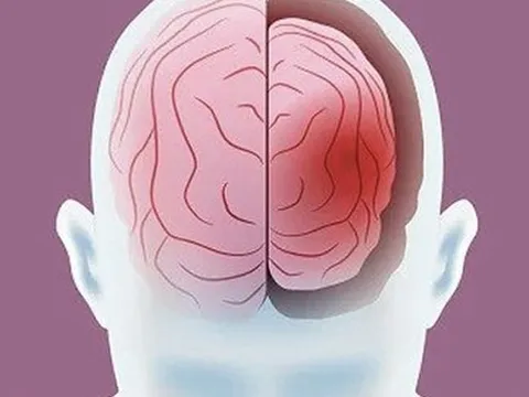 10 điều bộ não SỢ NHẤT: Có những hành vi dễ gây Alzheimer, teo não