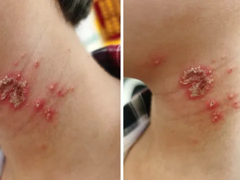 Bé trai 10 tuổi bỗng xuất hiện những nốt mẩn lạ trên da nhưng vẫn chưa tìm ra được nguyên nhân