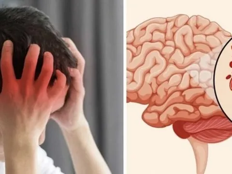 Sinh viên 22 tuổi đột quỵ lúc 4 giờ sáng phải lên bàn mổ ngay lập tức: Những dấu hiệu DỄ THẤY và ĐƯỢC BÁO TRƯỚC, nhưng bị xem nhẹ