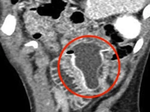 Bé trai 10 tuổi nôn mửa, đau bụng suốt 4 ngày, bác sĩ sốc nặng khi phát hiện "bí mật" đáng sợ