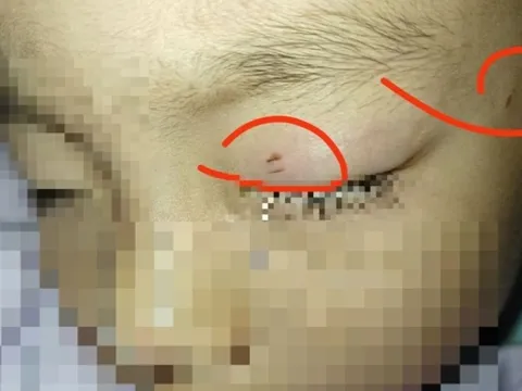 Cậu bé bị nhiễm trùng, mù một bên mắt vì hành động của giáo viên