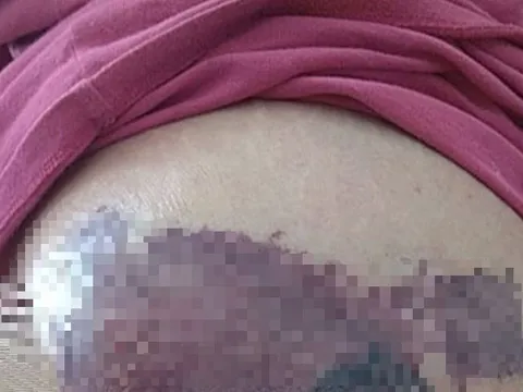 Người phụ nữ mới sinh ngực đột ngột chuyển màu đen, bác sĩ sốc nặng khi phát hiện "bí mật" đáng sợ