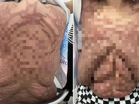 Người phụ nữ 40 tuổi, da biến dạng kinh hoàng vì sai lầm nhiều người mắc