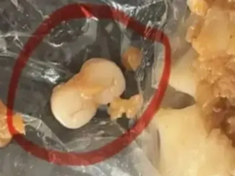 Người dân sốc nặng khi phát hiện răng người trong xúc xích, dimsum