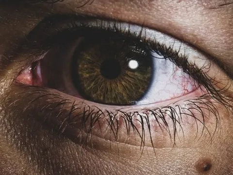 Tưởng nốt ruồi lộc trên mắt hoá ra mắc UNG THƯ DA, bác sĩ sửng sốt: Sai lầm chết người khi coi thường một ‘dấu chấm nhỏ’