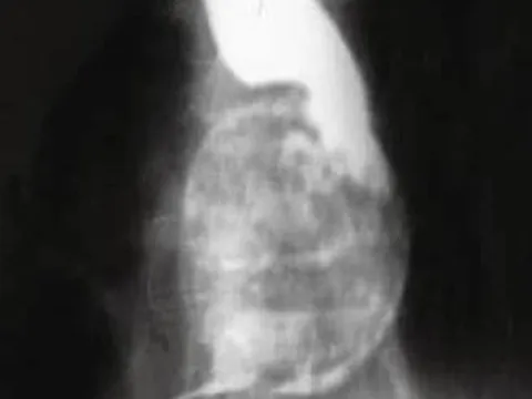 Người phụ nữ bị khó nuốt, bác sĩ phát hiện ra "bí mật" đáng sợ