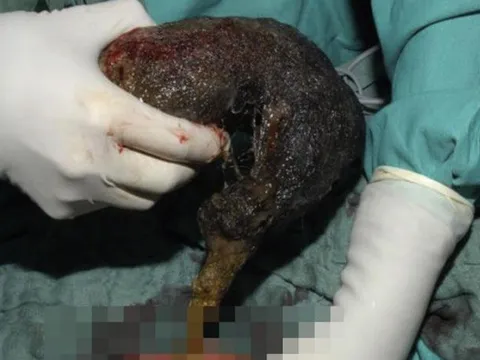 Bé gái đau bụng suốt 10 tháng, bác sĩ phát hiện ra "bí mật" đáng sợ