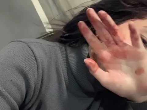 6 bất thường ở bàn tay đang ám chỉ lượng đường trong máu vượt ngưỡng an toàn, tiếc là rất ít người để ý!