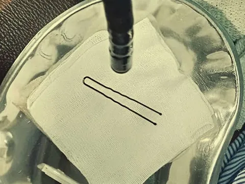 Bé gái 4 tuổi đột ngột khóc thét, vào viện bác sĩ gắp ra thứ "đáng sợ" bên trong