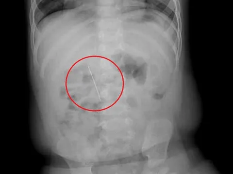 Bé trai 11 tháng khó chịu trong người, bác sĩ gắp ra thứ "đáng sợ"