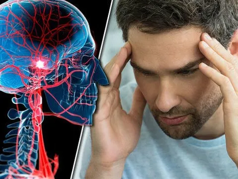 Thực hư chuyện "thoát khỏi đột quỵ trong gang tấc" chỉ với 2 động tác?
